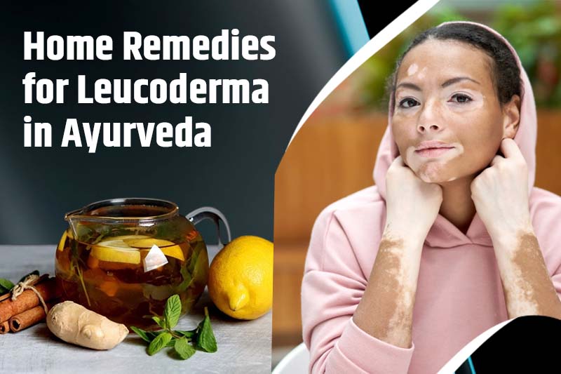 Home Remedies for Leucoderma in Ayurveda